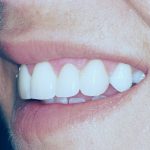 After dental treatment at Nagrani Dentistry